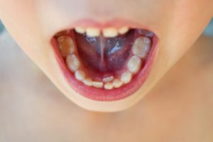Teeth – Rochester, MN – Apollo Dental